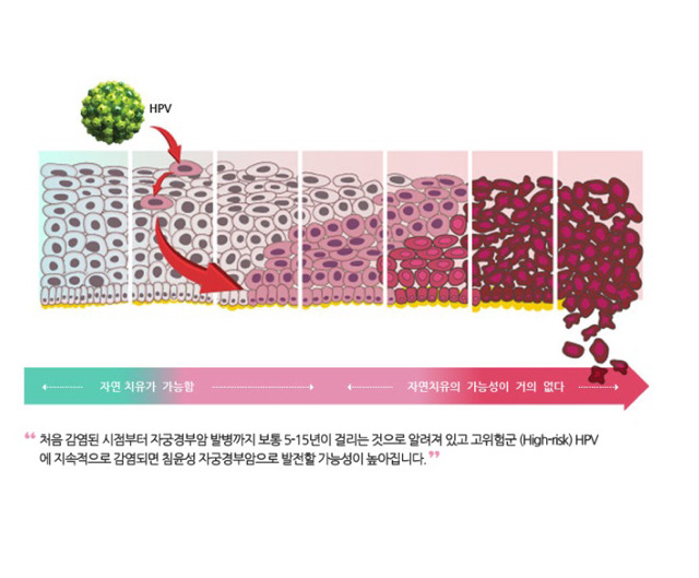 자궁경부암 제대로 알고 건강한 섹스하자 | 인스티즈