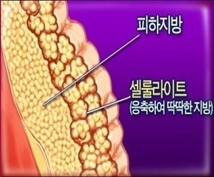 셀룰라이트 | 인스티즈
