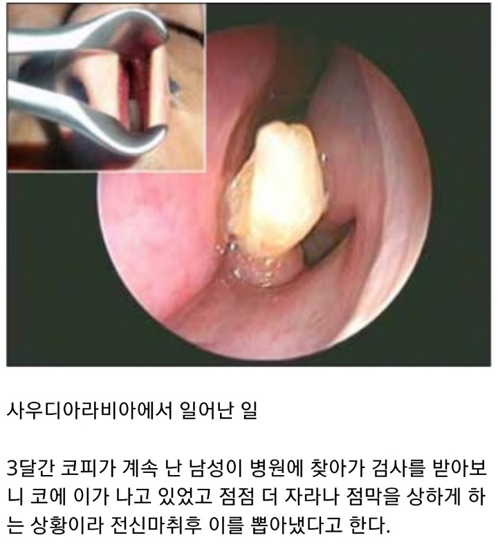 코에서 치아가 자라난 남성 | 인스티즈