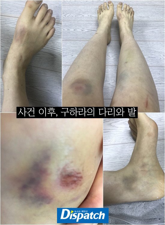 구하라 디스패치 멍든 사진 | 인스티즈